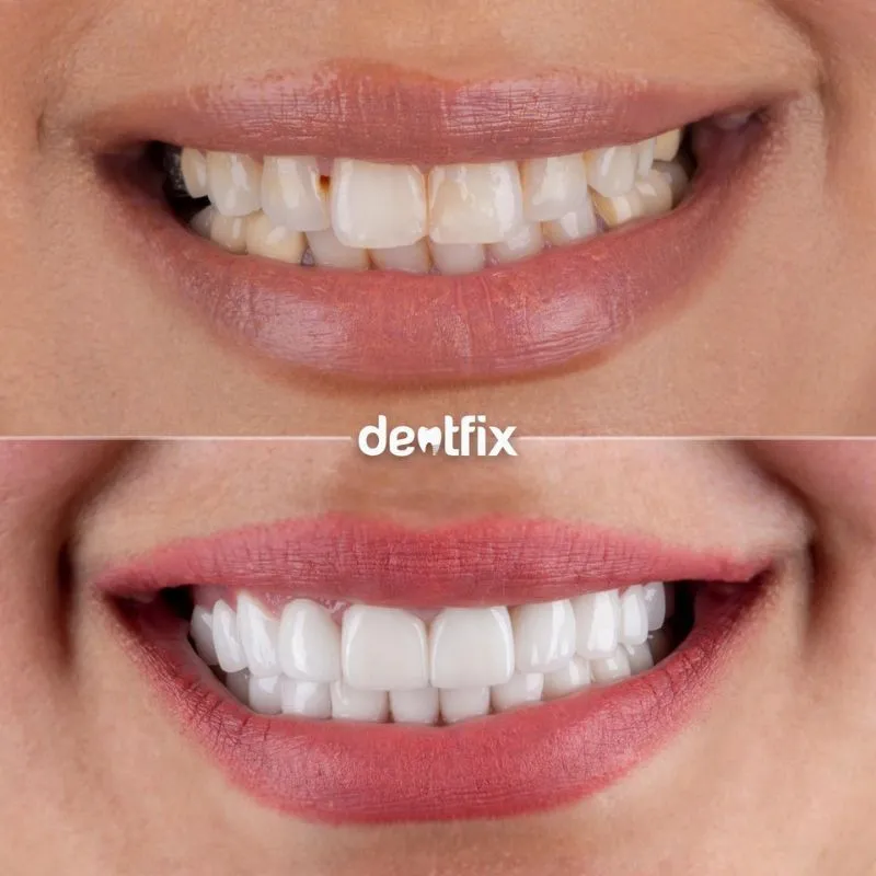 Veneers Türkei